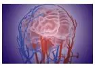 The Science Behind Aneurysm Brain Surgery Exploring Treatment Options